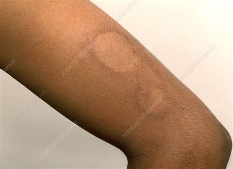 Tuberculoid leprosy - Stock Image - C049/8031 - Science Photo Library