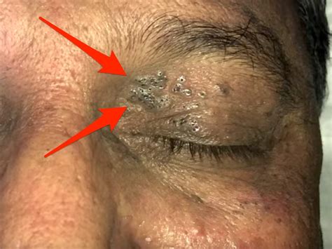 People loved this 50-year-old blackhead removal video -- and now th...