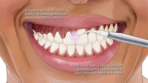 Gingivectomy Logan, UT - Garland, UT - Gregory E. Anderson PC