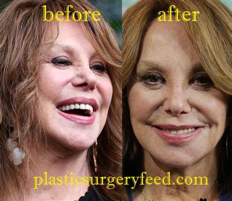 Marlo Thomas Plastic Surgery - Plastic Surgery Feed