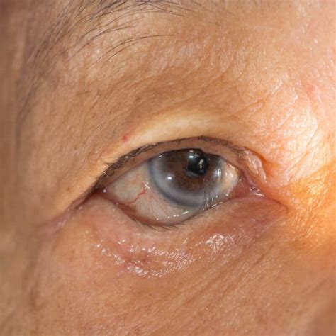 Entropion Surgery Stockton | Entropion Symptoms Lodi | Delta Eye