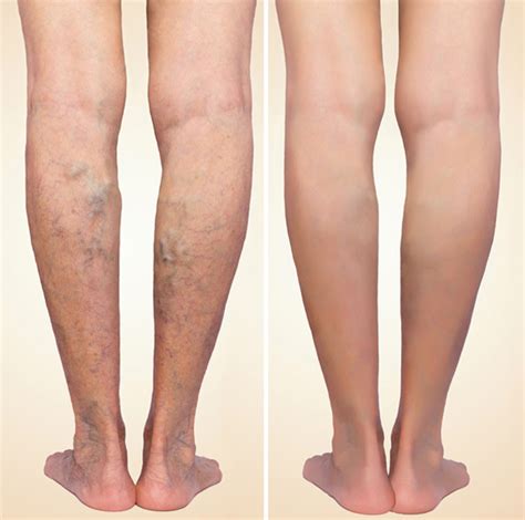 Varicose Veins Treatment Beverly Hills | Laser Vein Removal Los Angeles