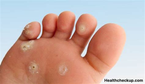 Cutaneous warts - Symptoms, Diagnosis, Treatment, Prevention