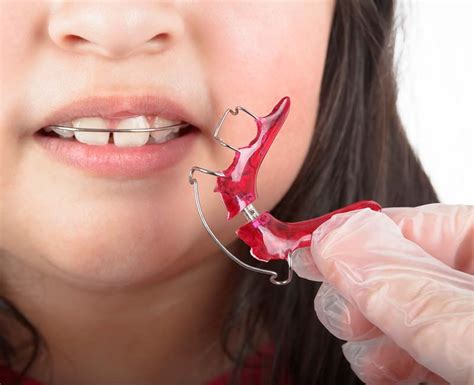 Teeth Retainer: How it Works, Types & Uses