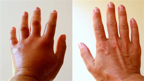 Doctors Explain What Swollen Hands Reveal About Your Health