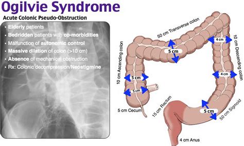 Ogilvie syndrome causes, symptoms, diagnosis, treatment & prognosis