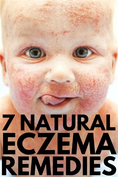 Eczema Treatment