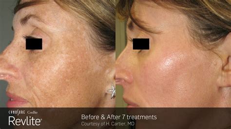 Pigmentation Treatments – Lincoln Laser Skin Care