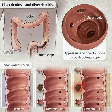 Diverticulosis & Diverticulitis | Gastroenterology, Medical anatomy ...