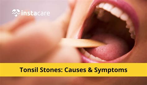 Tonsil Stones - Causes Symptoms And Treatment