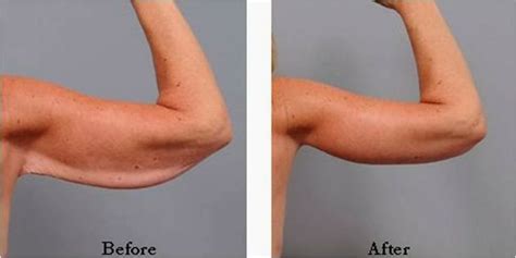 Liposuction before and after arms