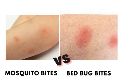 Mosquito Bites Vs Bed Bug Bites – Theme Route