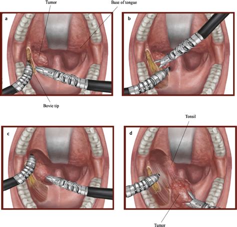 Tonsillectomy Procedure Step By Step