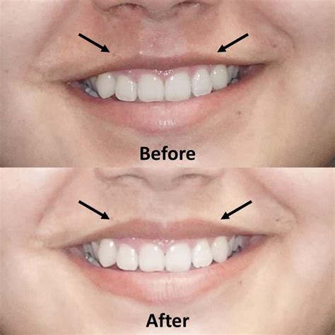 Lip Flip Botox Before And After Photos | Sitelip.org