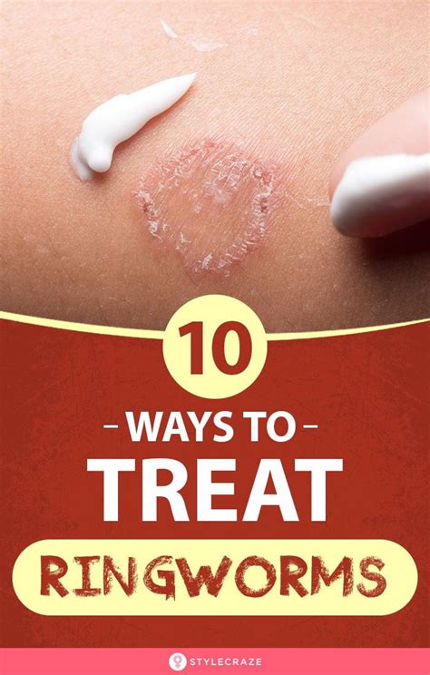 10 Ways To Treat Ringworms in 2020 | Home remedies for ringworm ...