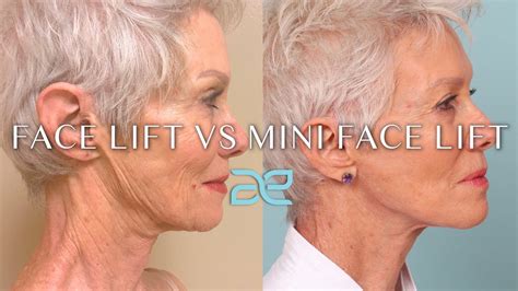 Facelift vs. Mini Facelift - YouTube