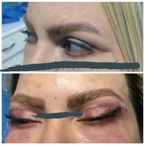 49 Best Pictures Cat Eye Surgery Before And After - Cat Eye Cosmetic ...