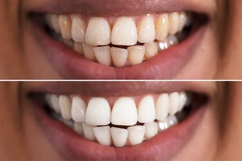 Teeth Whitening - Brighter Smiles