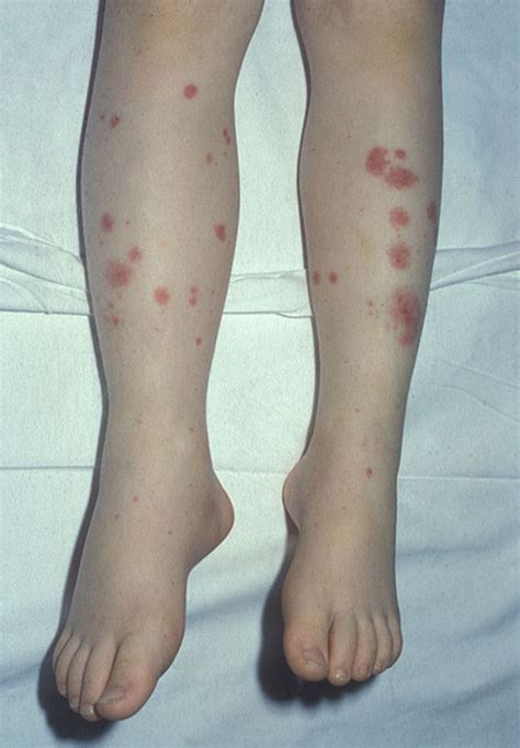 Petechiae Leukemia Children