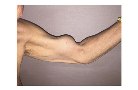 Here's Why a Man's Arm Looks Like Popeye's | Live Science