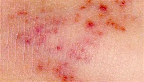 Meningitis rash: Pictures, symptoms, and similar rashes - Medical News ...