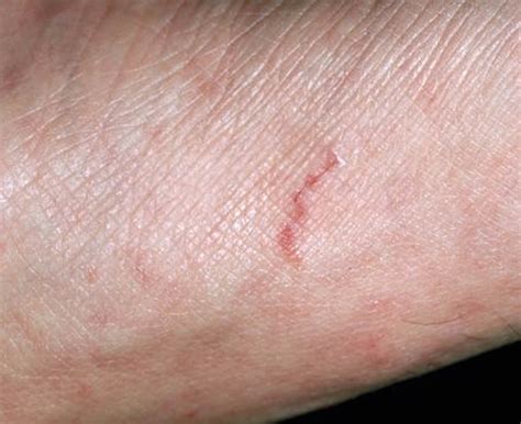 Scabies - Signs, Symptoms, OTC Treatment & Home Remedies