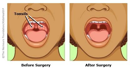 tonsil removal surgery - Jeffrey Decarvalho