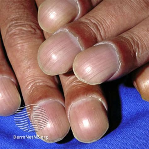 4 Ways HIV May Affect Your Nails | myHIVteam