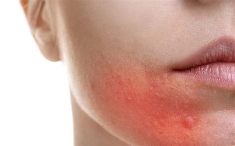 Allergic Rash | Dr Joycelim Dermatologist & Skin Specialist