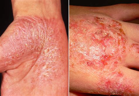 Plaque Psoriasis Vs Eczema