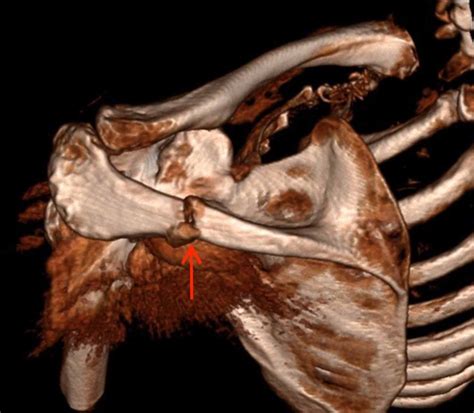 Spine of scapula - libraryrewhsa