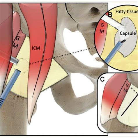 Outside-in capsulotomy technique. (A) The anterior surface of the ...