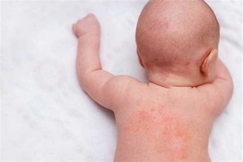 How to treat baby rashes at home: tips and remedies!