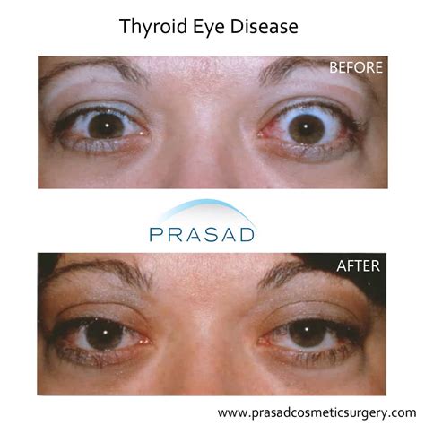 Thyroid Eye Disease Surgery/ Graves Eye Disease Surgery