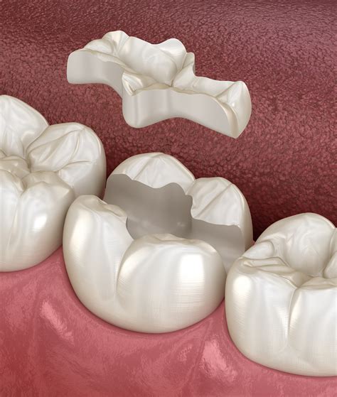 Inlays & Onlays: Aesthetic Solutions for Dental Cavities