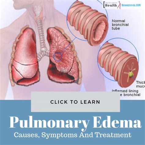 Pulmonary Edema: Causes, Picture, Symptoms And Treatment