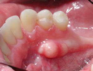 What Are Mandibular Tori: Insights on Causes, Symptoms, and Management