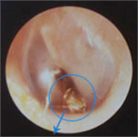 Treatment for Hearing Loss | Speech Delay | Ear Nose Throat Problems ...