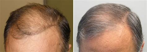 Finasteride Before and After Photos [2024]