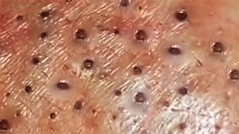 Blackheads Milia Big Cystic Acne Blackheads Extraction Whiteheads ...