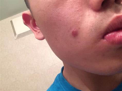 Infected Pimple? Need Help. – General acne discussion – Acne.org Forum