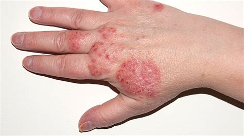 Eczema - Singhania Skin Clinic