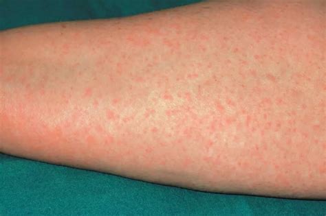 How Long Does A Drug Reaction Rash Last | Allergy Differences