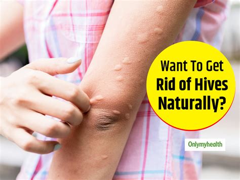 Irritated With Hives? Try These Effective Natural Remedies | OnlyMyHealth