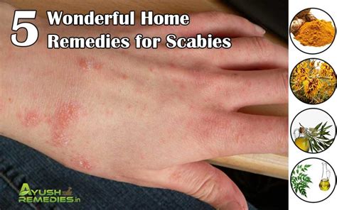 5 Home Remedies for Scabies, Treatment to Get Rid of Scabies