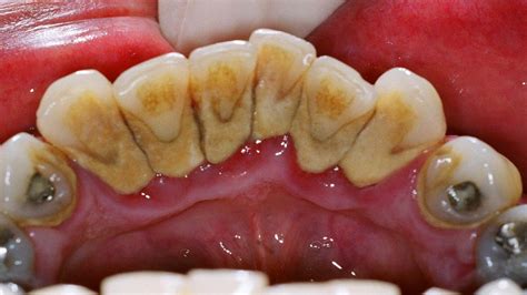 plaque calcification teeth - Teeth Bonding