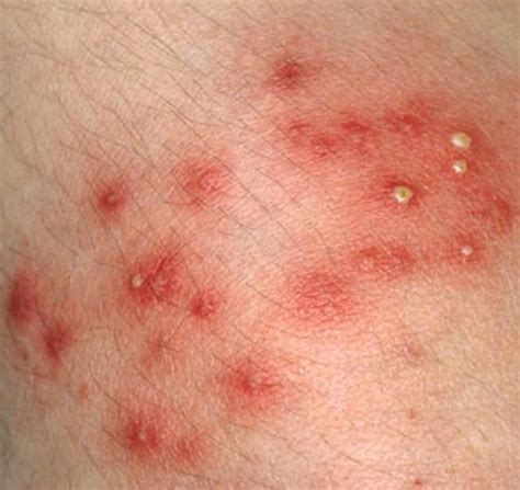 Staph Infection: Causes, Contagious, Symptoms, Treatment, and Pictures ...