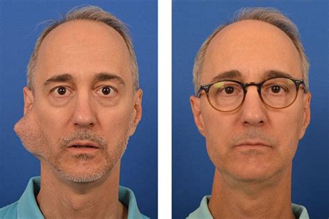 Incredible results after large parotid tumor removed by Dr. Larian in ...