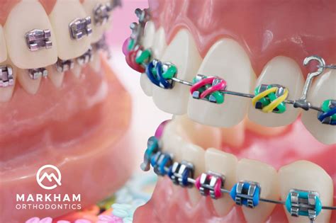 How to Choose the Right Braces Colors - Markham Ortho