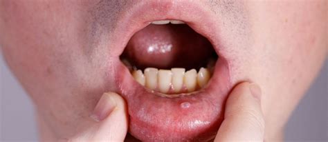 Mucocele Surgery in Panama - What is it and when to do it?